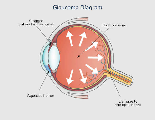 glaucoma-diagram