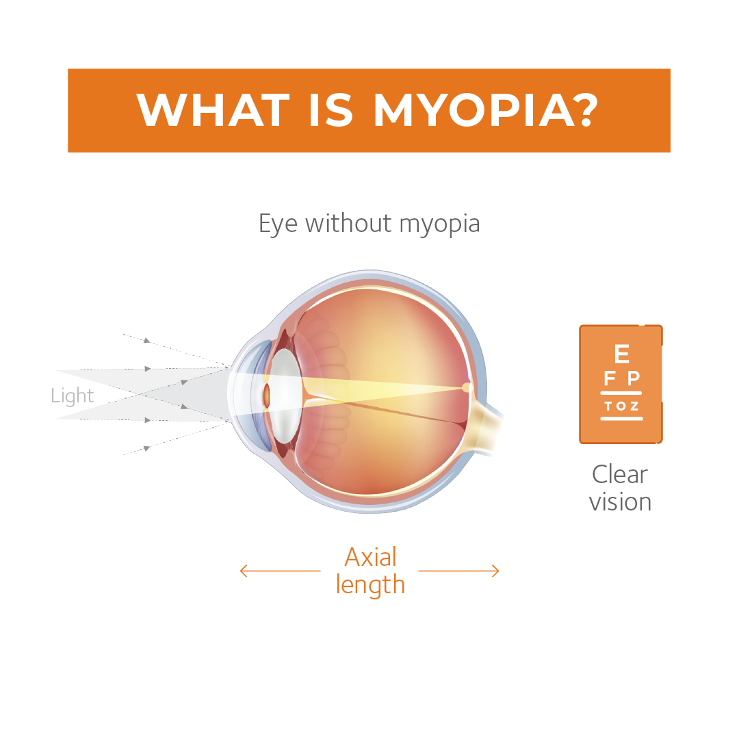 Myopia in Children 2