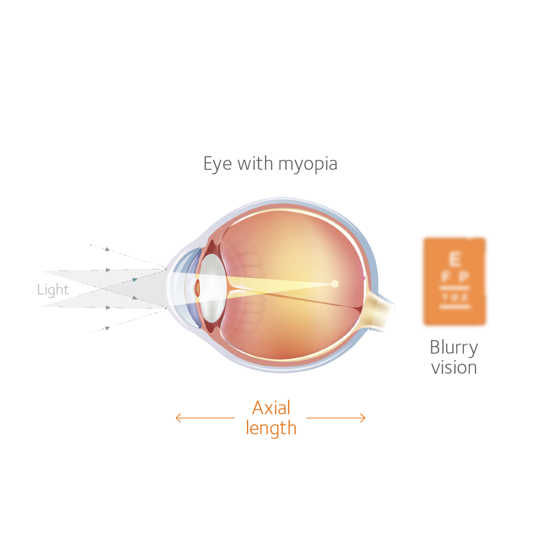 Myopia in Children 3