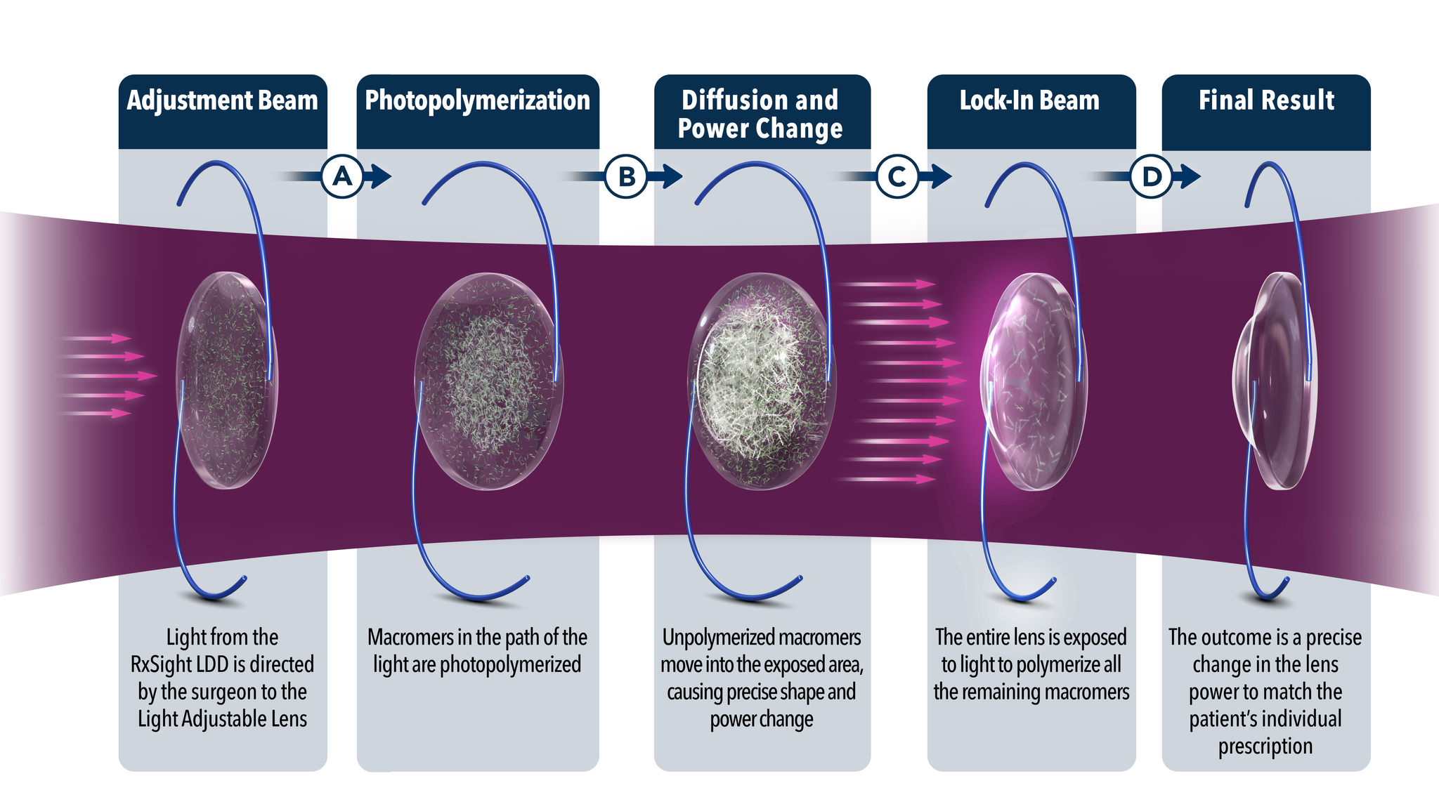 RX Sight Process of Light Adjustable Lens for Cataract Surgery