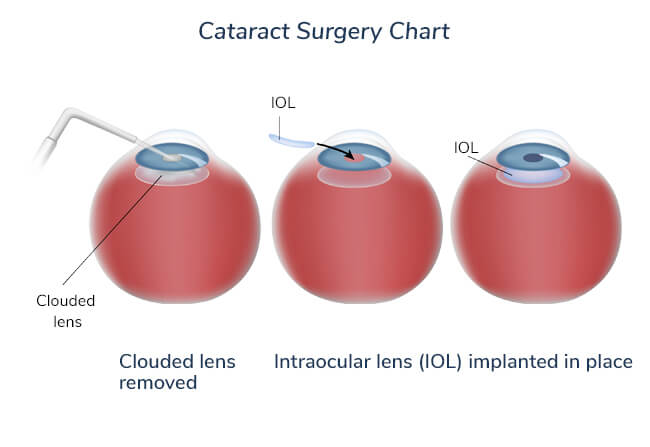cataract-surgery-chart-1
