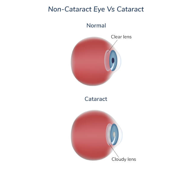 cataract-symptoms-2