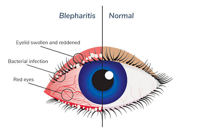 blepharitis
