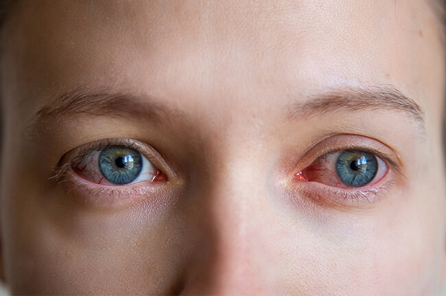 conjunctivitis-GPC