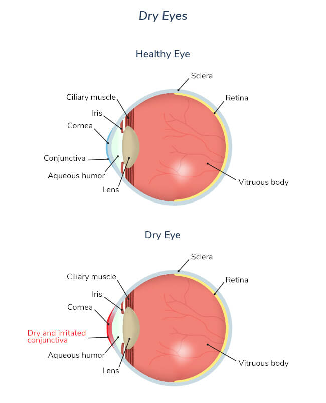 dry-eye-syndrome-dry-eye