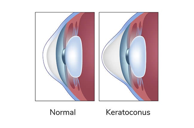 Keratoconus