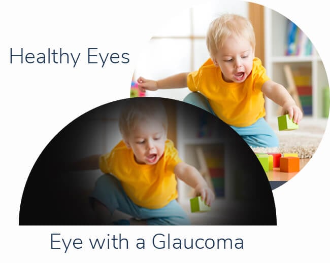 eye-with-glaucoma