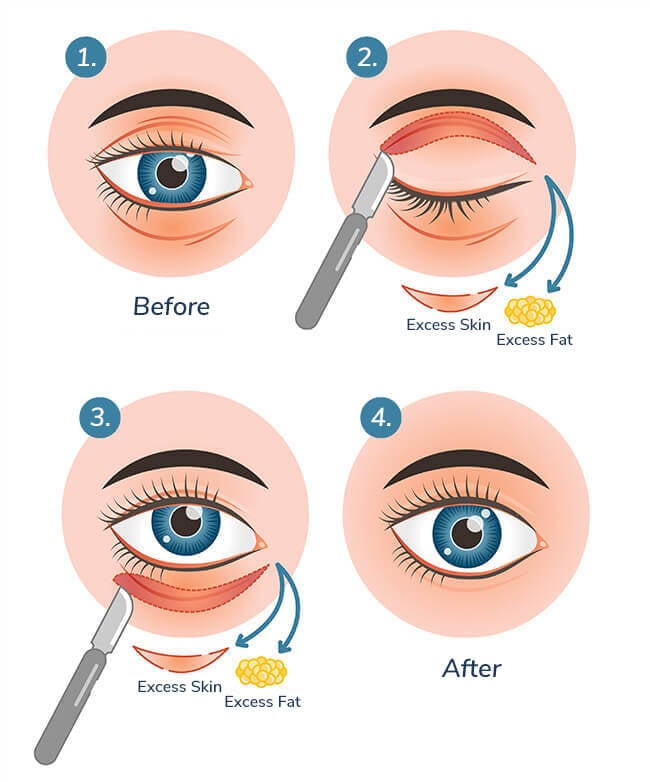 blepharoplasty-process