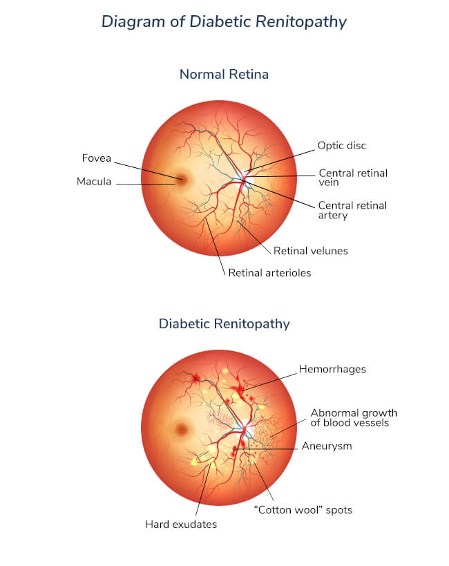 diabetic-renitopathy