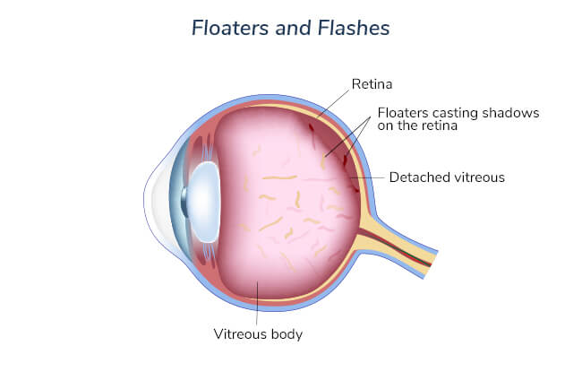 floaters-and-flashes
