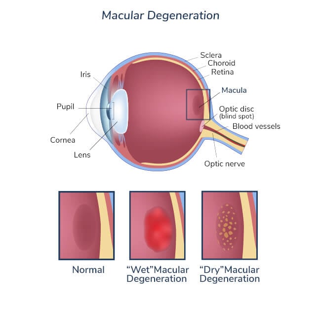 macular-degeneration