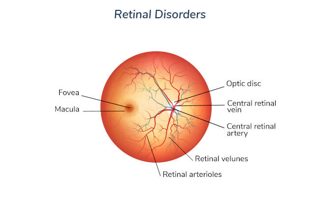 retinal-disorders