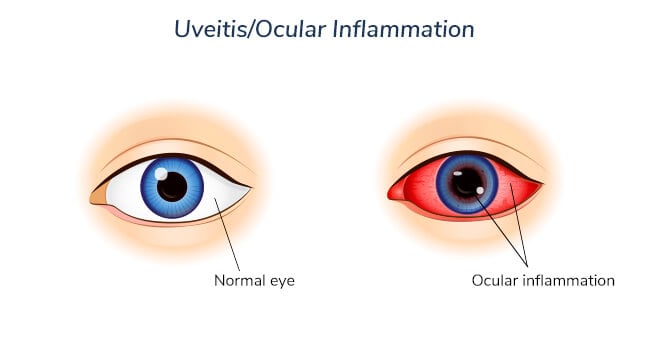 uveitis-ocular-inflammation